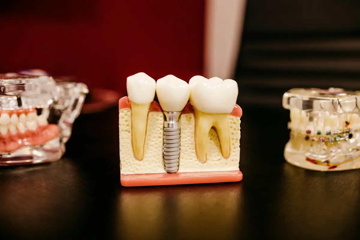 A model of a dental implant with a crown, between two natural teeth