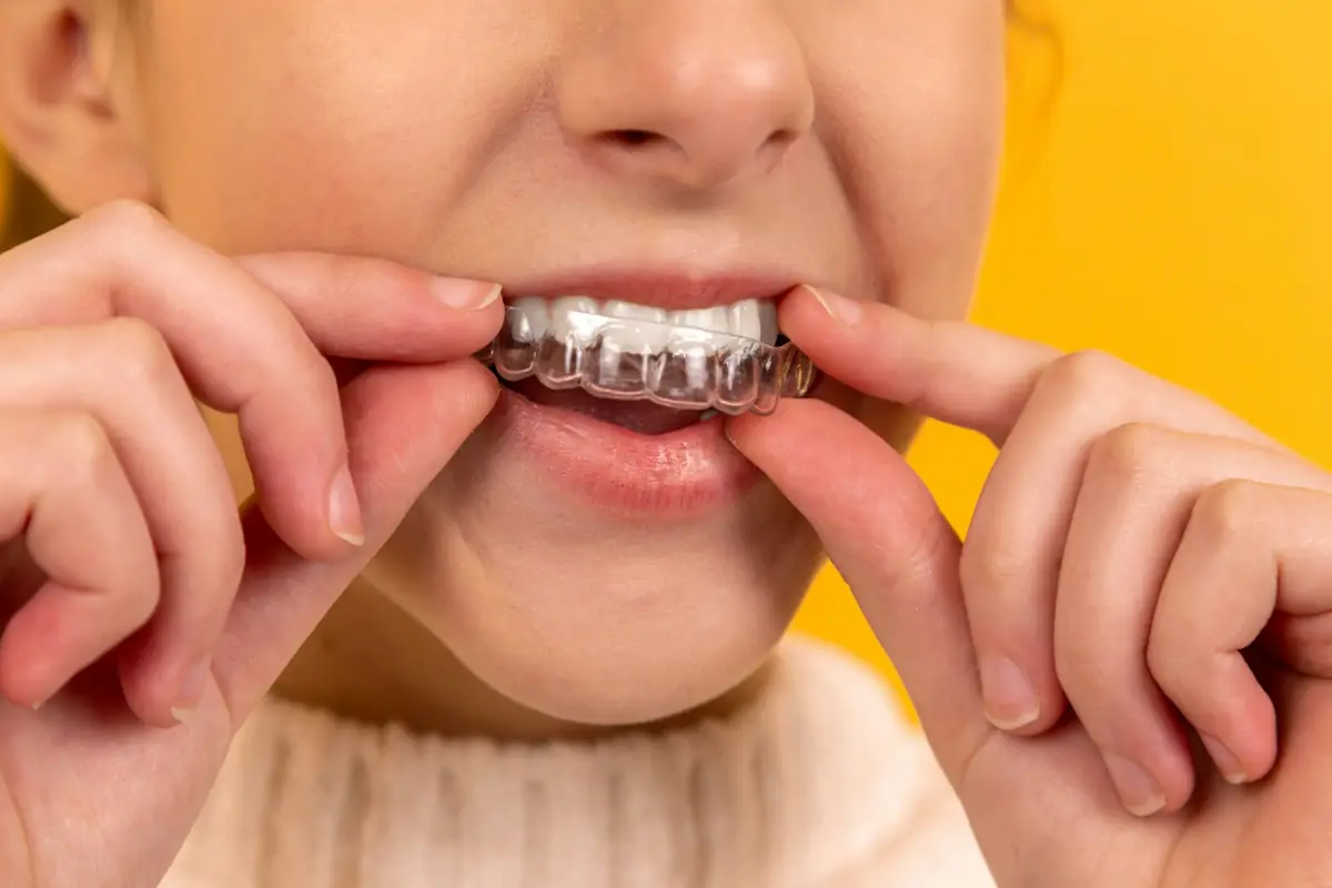 A young woman putting in a clear aligner